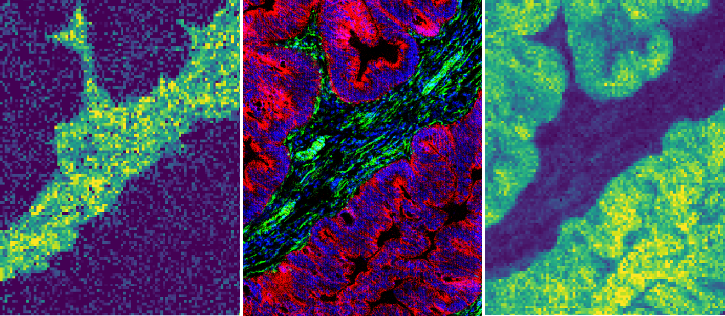 Deze drie plaatjes tonen precies hetzelfde stukje weefsel, maar met verschillende kleuringen, waardoor verschillende dingen te zien zijn. Het middelste plaatje is gemaakt met imaging massa-cytometrie (IMC) en toont in het rood de tumorcellen en in het groen de immuuncellen. De plaatjes links en rechts zijn gemaakt met imaging massaspectometrie (MS) en tonen twee verschillende metabolieten.