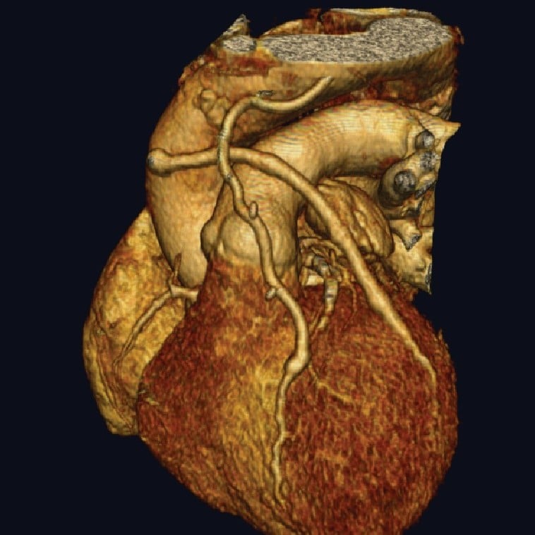 Atherosclerosis, Vascular Biology & Inflammation | LUMC